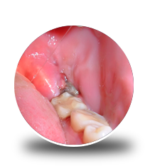 Wisdom Teeth Infection Treatment